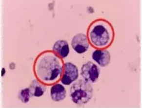 突然确诊<strong></p>
<p>货币利率掉期</strong>!90后女子傻眼:不痛也不痒……很多人发现就是晚期