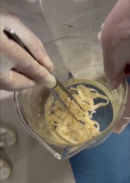 女子体内排出10米长绦虫<strong></p>
<p>债券交易流程</strong>!原是两年前旅游时吃了这种食物