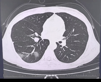 查出流感没在意<strong></p>
<p>p币</strong>,女子硬扛三天后肺都“白”了……