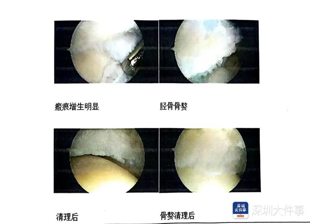 “一走路就痛”！女子脚踝受伤遭漏诊，治了7年没好！深圳一医院被告上法庭
