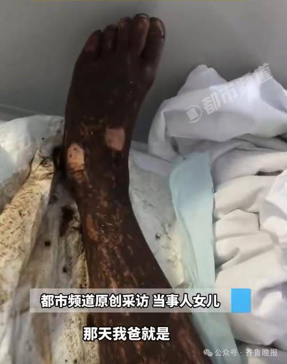 安徽宣城一男子走路玩手机<strong></p>
<p>比特派App</strong>,一脚踩中打架的竹叶青和五步蛇,被俩毒蛇咬3口!医院:暂无生命危险,正在治疗