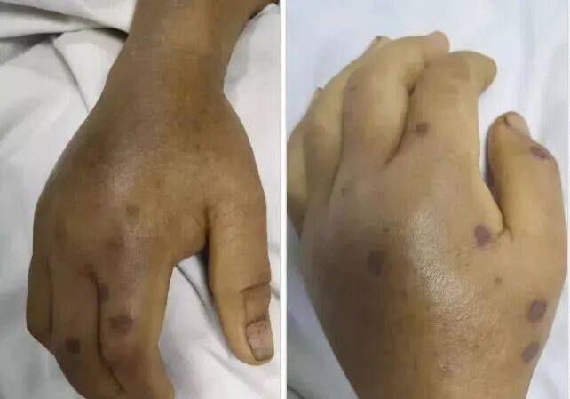 深圳一市民突遭马蜂围袭!已进入高发期<strong></p>
<p>币安官网入口</strong>,千万别招惹!