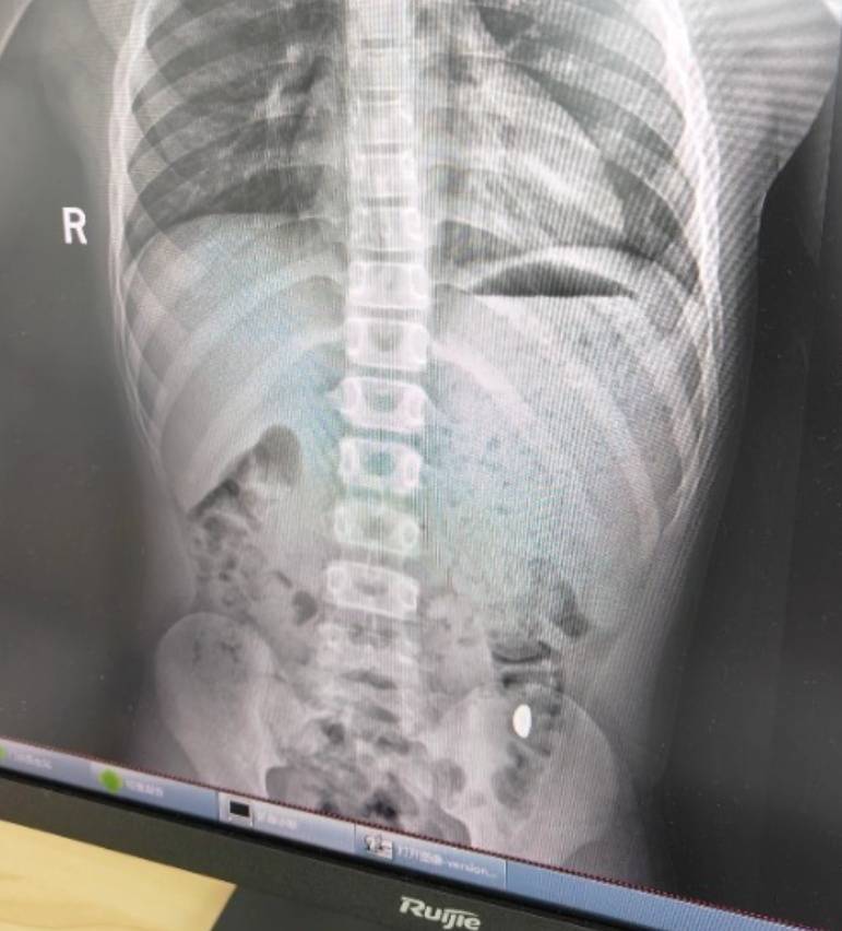 “熊孩子”误吞10克重金豆<strong></p>
<p>ERC20</strong>,妈妈:天天叮嘱他不要在外面拉屎