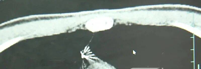 17岁小伙参军体检发现胸腔内有根5cm缝衣针<strong></p>
<p>偿债基金系数</strong>,父母回忆或是1岁时扎入,取出时已锈迹斑斑