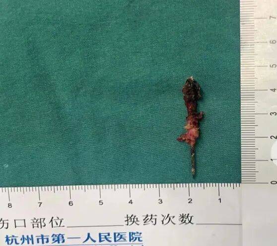 17岁小伙参军体检发现胸腔内有根5cm缝衣针<strong></p>
<p>偿债基金系数</strong>,父母回忆或是1岁时扎入,取出时已锈迹斑斑
